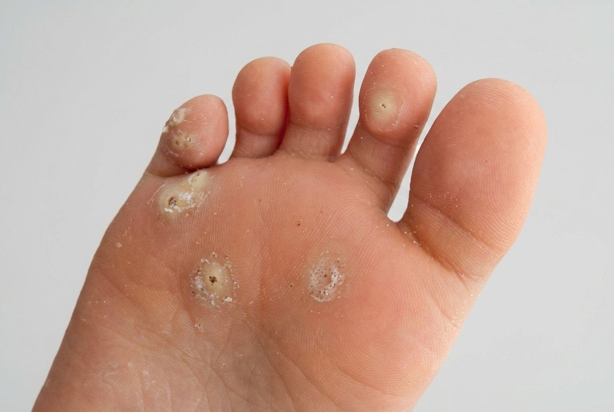 A foot with several verrucas